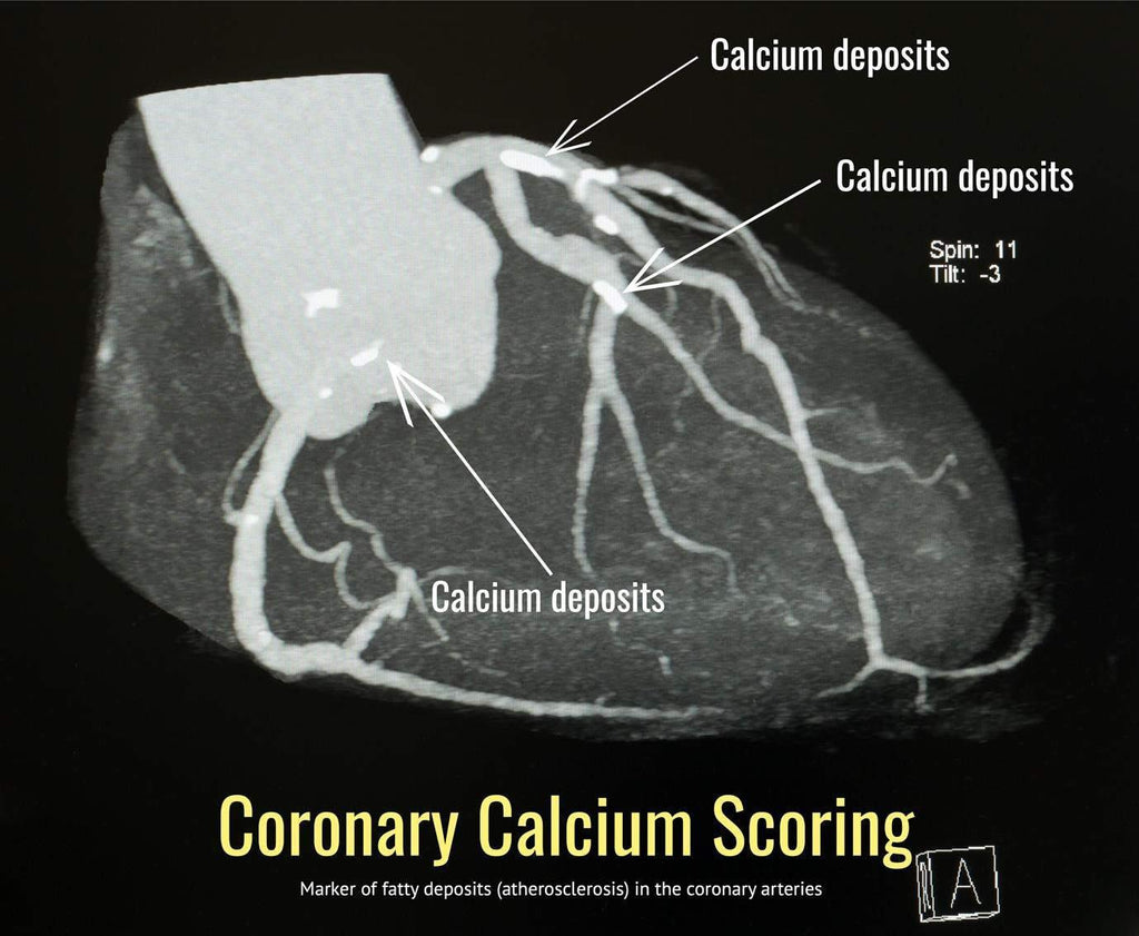 ct coronary calcium score test