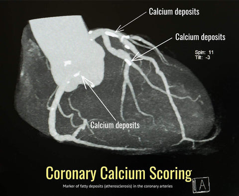 Coronary Calcium Score - SDBrainCenter