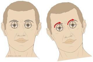 Diagram of head tilting with marked eye focus, illustrating possible neurological issues