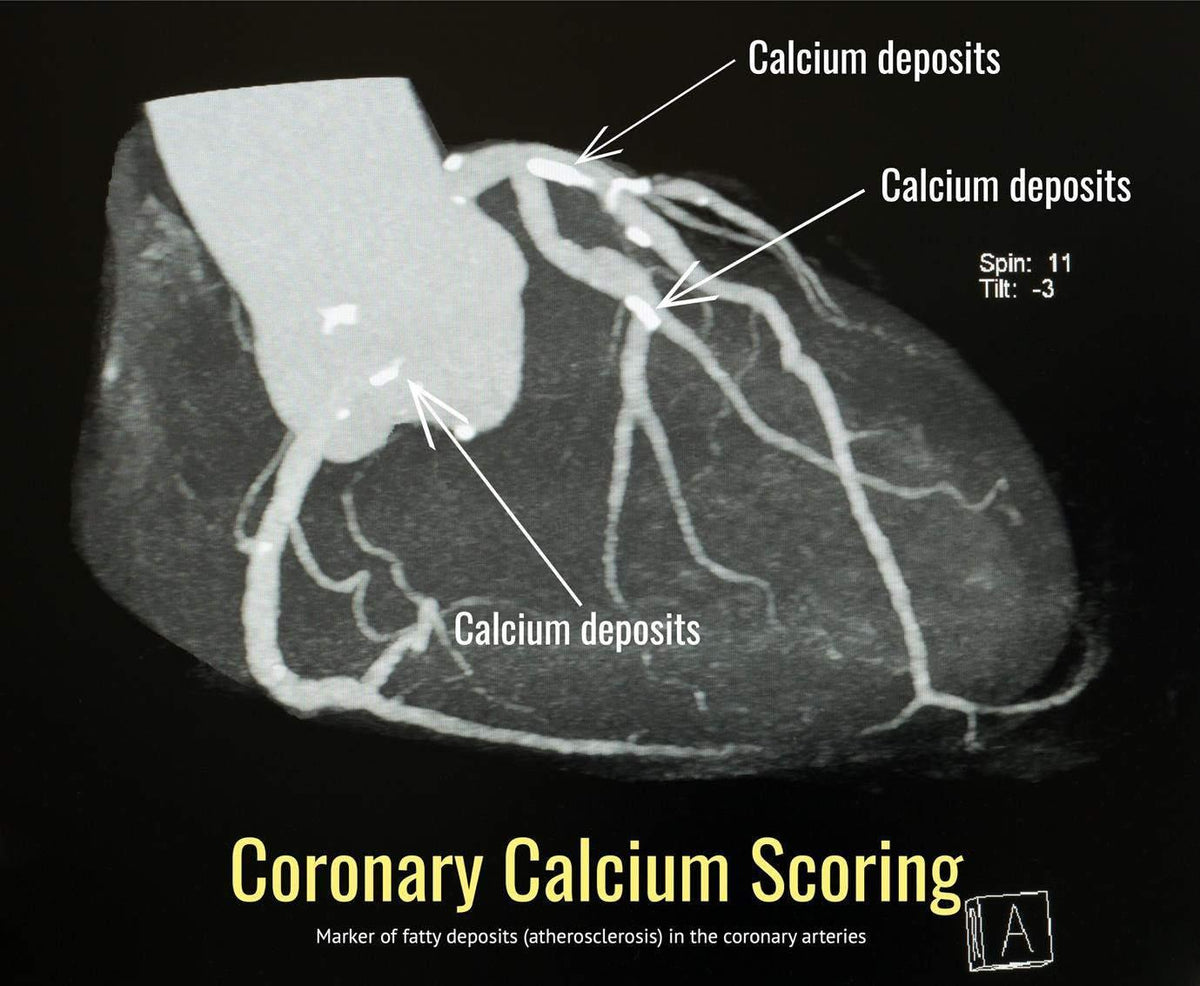 CT scan showing coronary arteries with labeled calcium deposits, coronary calcium scoring
