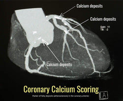 Coronary Calcium Score - SDBrainCenter